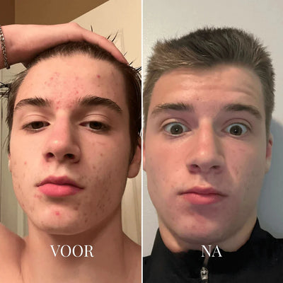 Porify – Effektiv borttagare av pormaskar