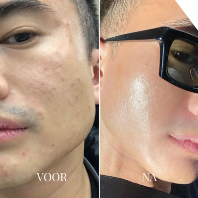 Porify – Effektiv borttagare av pormaskar