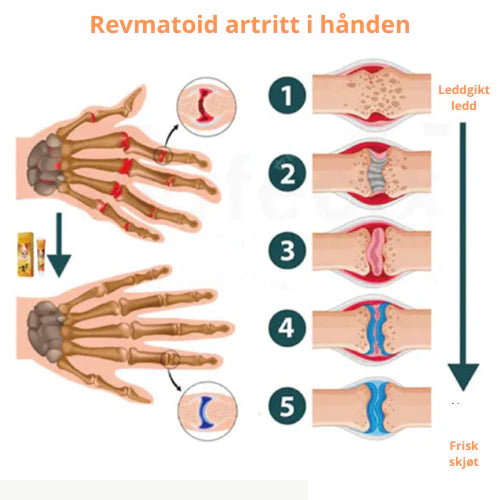 PROPOLIS PROFESSIONAL TREATMENT GEL FOR BEINSMERTER | 1+1 GRATIS!