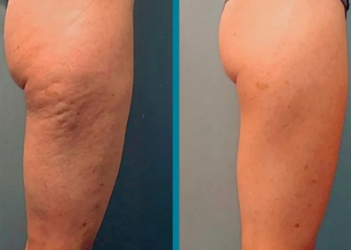 Velora™ Anti-Cellulite Oil Synligt slätare hud på 2–6 veckor