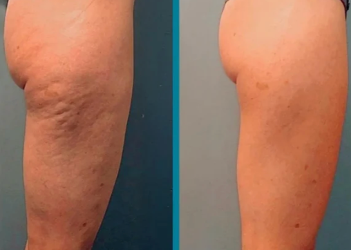 Velora™ Anti-Cellulite Oil Synligt slätare hud på 2–6 veckor