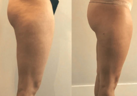 Velora™ Anti-Cellulite Oil Synligt slätare hud på 2–6 veckor
