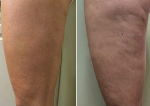 Velora™ Anti-Cellulite Oil Synligt slätare hud på 2–6 veckor