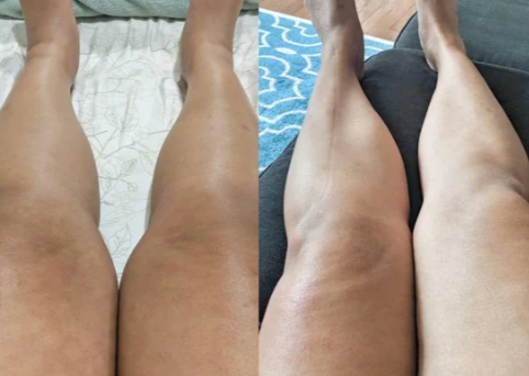 Velora™ Anti-Cellulite Oil Synligt slätare hud på 2–6 veckor