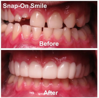 SecureSmile™ Reliner Kit