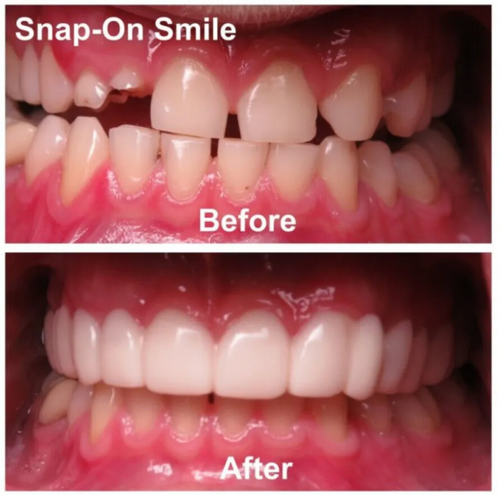 SecureSmile™ Reliner Kit