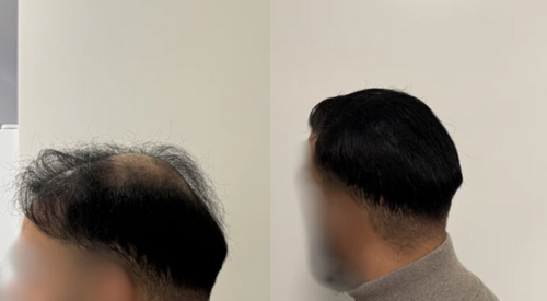 Nova™ Hairfillup  Naturlig Utseende og Vannavstøtende Beskyttelse