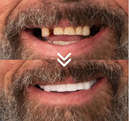 Selvsikkert smil på få minutter – uden tandlægebesøg, uden smerte og uden store omkostninger