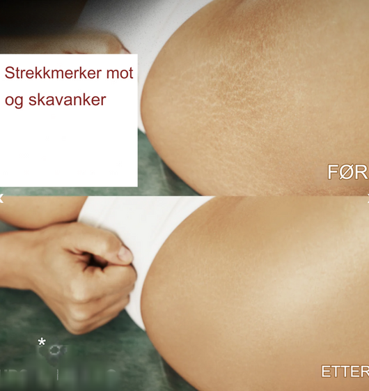 Firming™ | Fast og oppstrammet hud med 99 % etter 1 uke