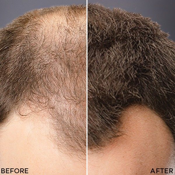 Toppik Hair Thickening – Für volleres, dichteres und gesünder aussehendes Haar in Sekundenschnelle!